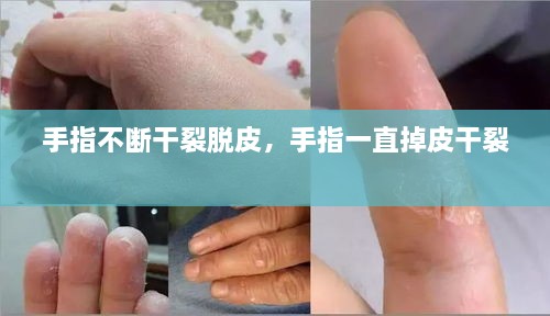 手指不断干裂脱皮，手指一直掉皮干裂 