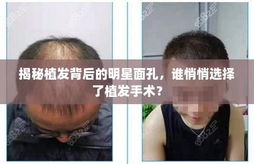 揭秘植发背后的明星面孔，谁悄悄选择了植发手术？